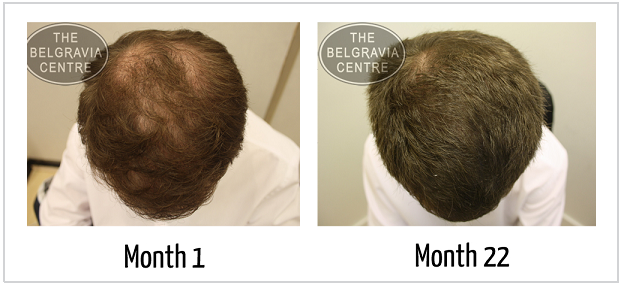 Belgravia-Centre-Hair-Loss-Successful-Treatment-Pictures-Male-Pattern-Baldness2.png