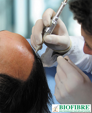 Biofibre-Hair-Implants-System-hair-transplant-synthetic-hair.jpg