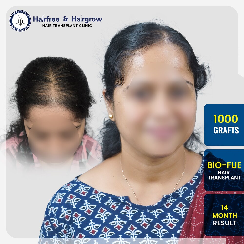 Blur_rohini-kandalgaokar-1000-grafts-bio-fue-hair-transplant-14-month-result-pune.jpg.jpg
