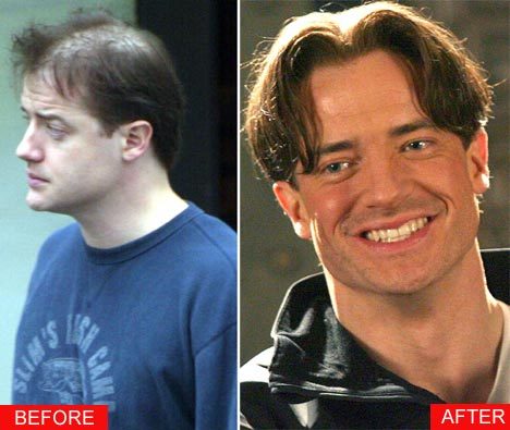 Brendan-Frader-Hair-Transplant.jpg