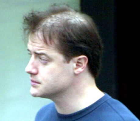 brendan-fraser-thinning-hair.jpeg