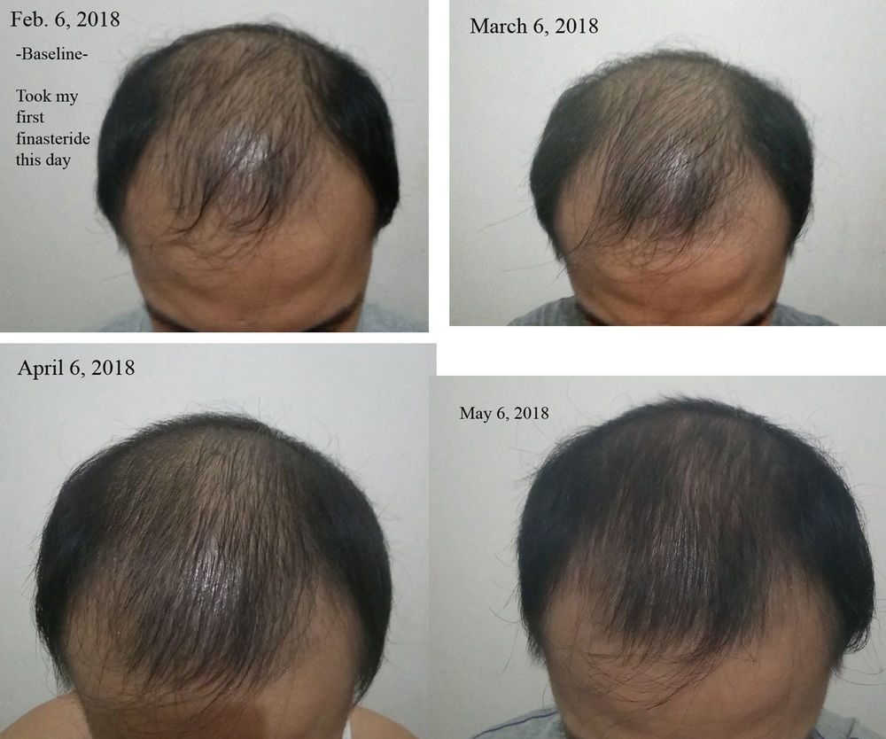 using finasteride for 3 months