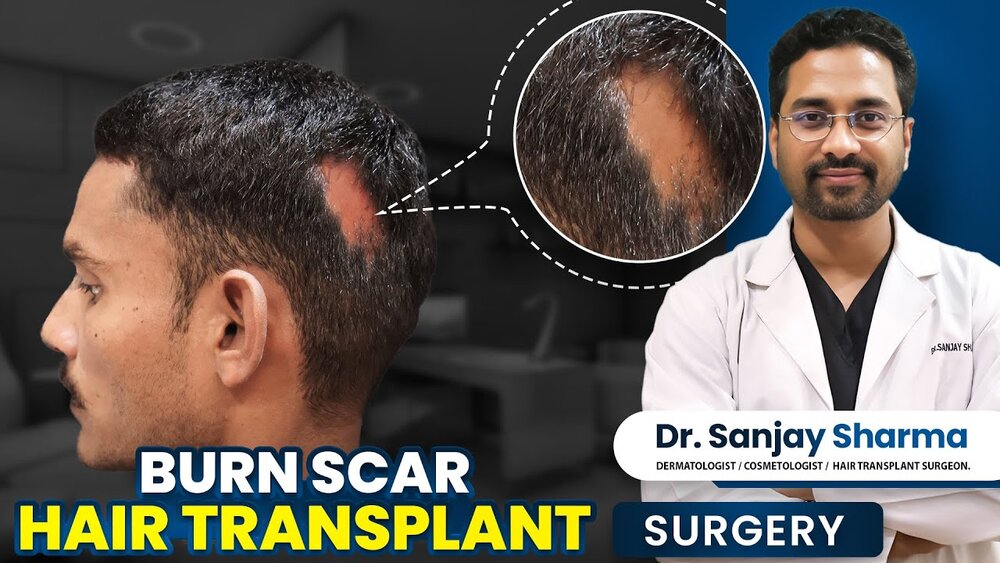 Burn Scar Hair Transplant Success.jpg