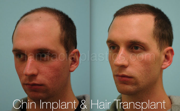 chin-augmentation-bxa-17.jpg