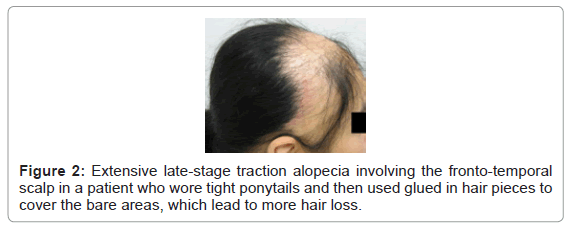 clinical-experimental-dermatology-hair-loss-2-117-g002.png