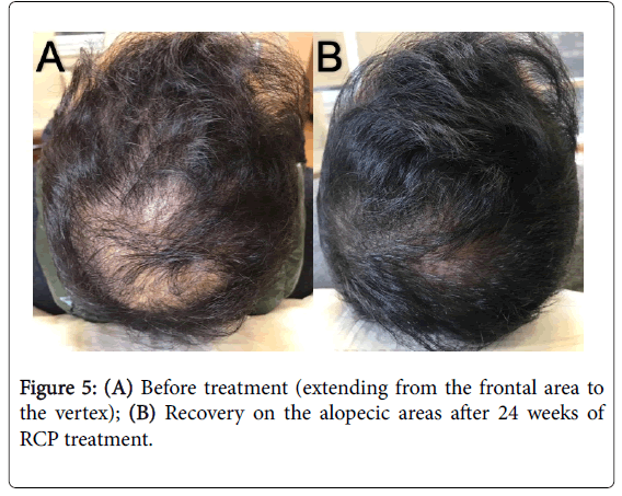 cosmetology-trichology-alopecic-areas-5-137-g005.png