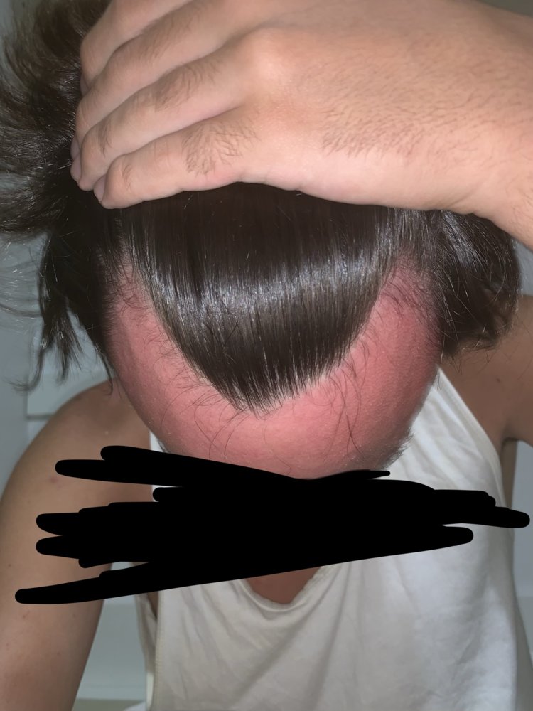 is minoxidil bad for receding hairline