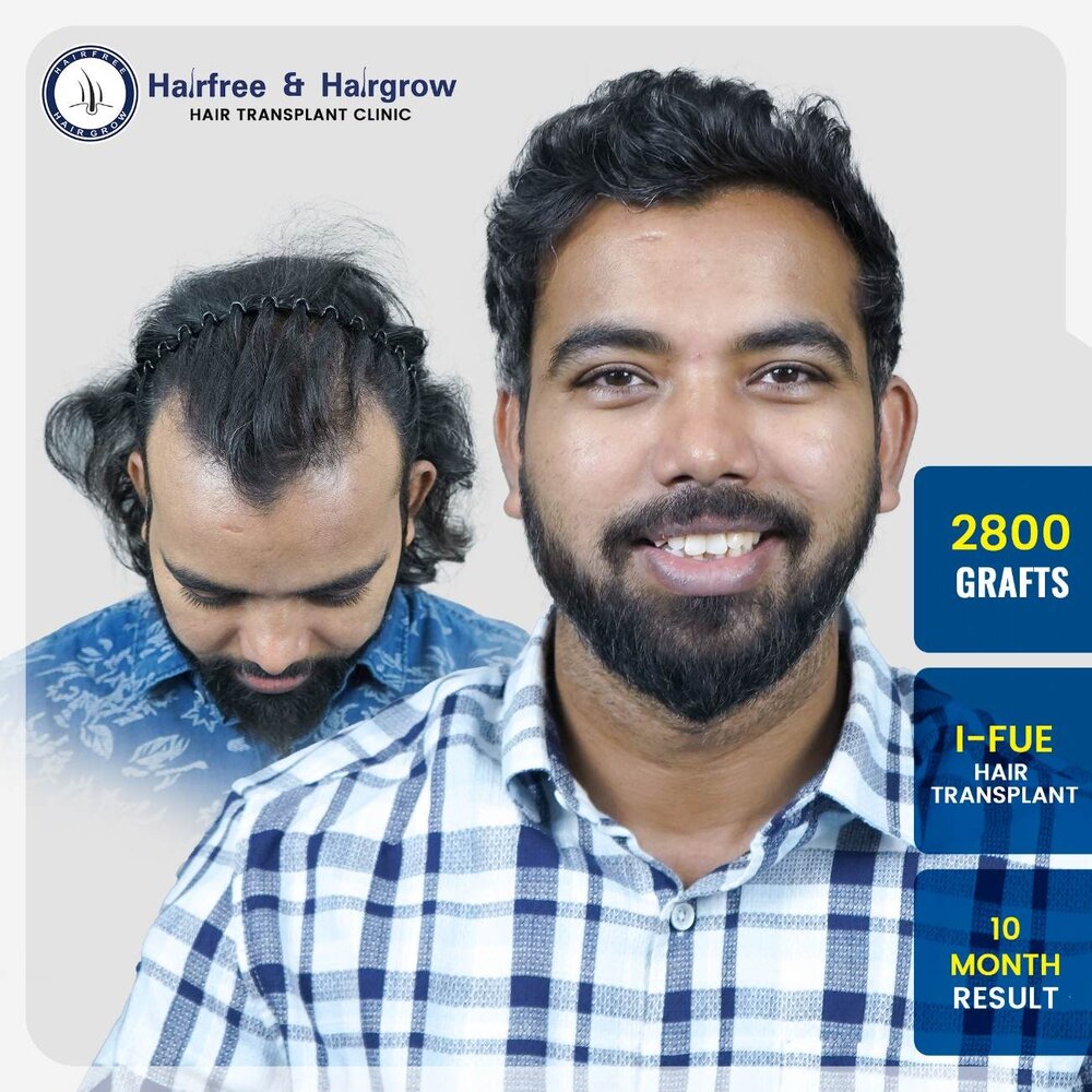 dadasaheb-tadwalkar-2800-grafts-i-fue-hair-transplant-10-month-result-pune-india.jpg-200kb.jpg