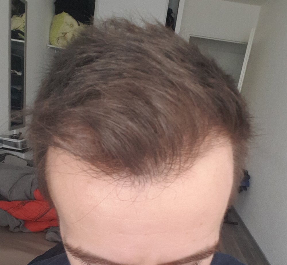 Derma roller 4 mois.jpg