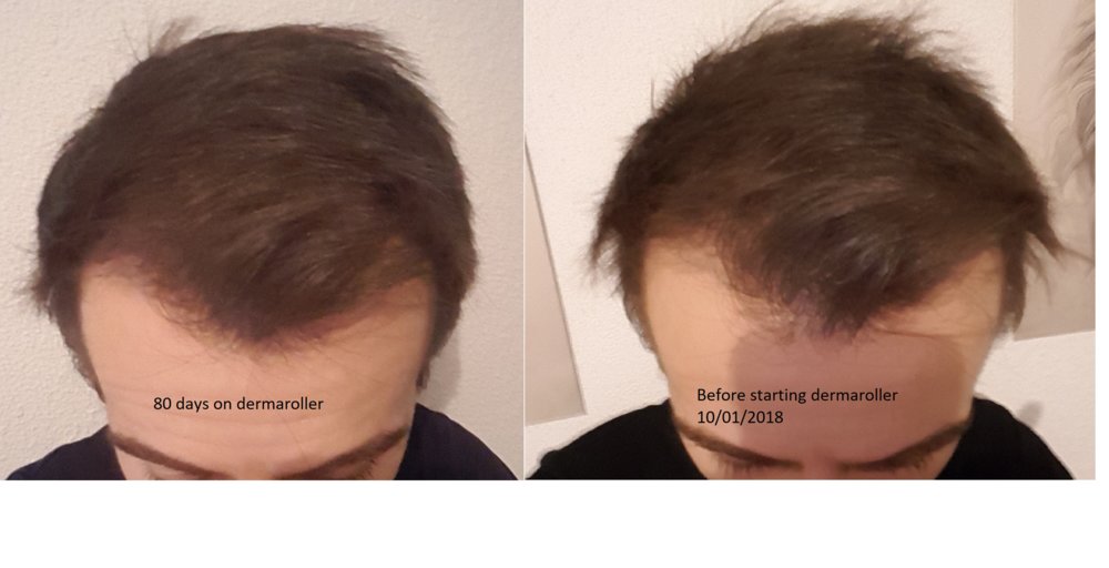 dermaroller.jpg