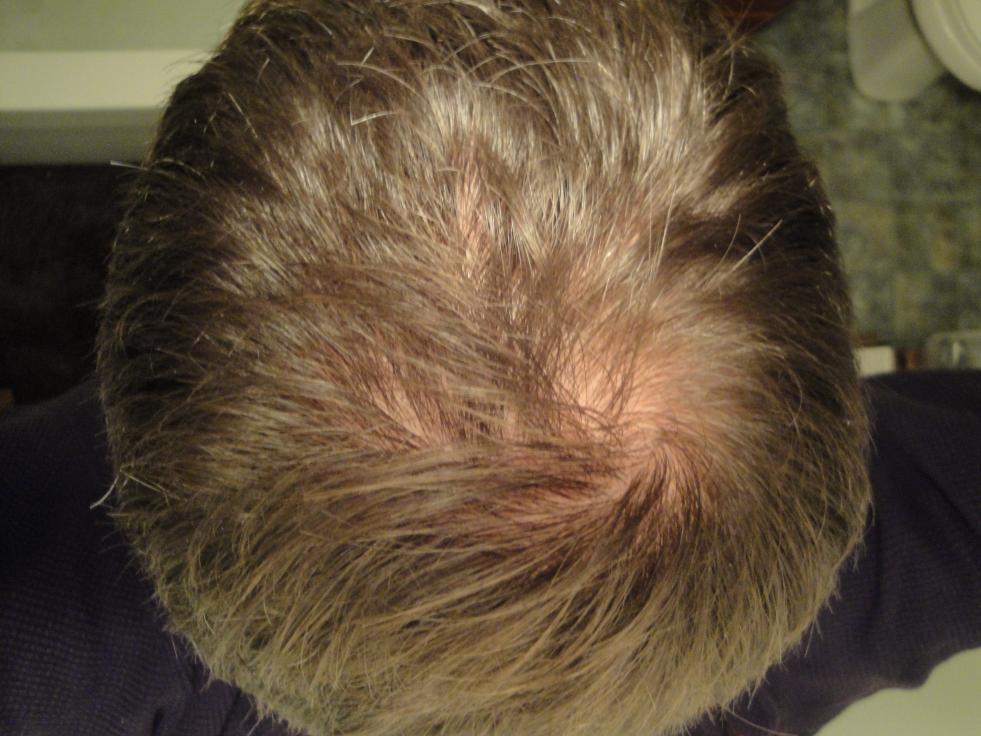 Hairstyles For Thinning Hair Crown Kuora O