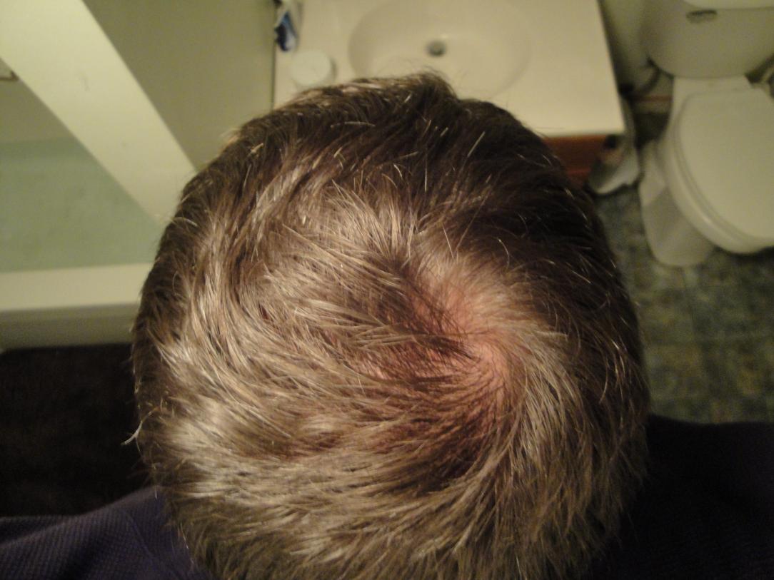 Help With Sudden Thinning On The Crown With Burning And Itching