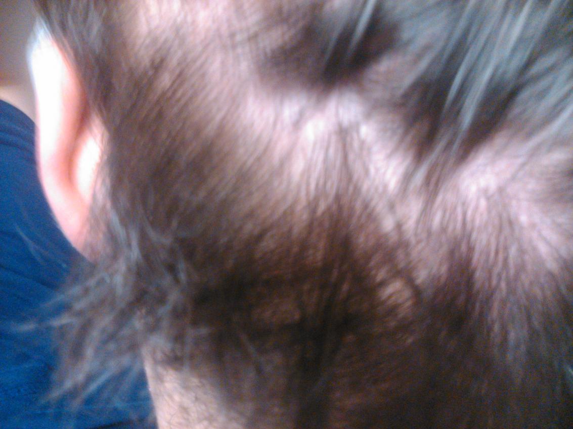 How Bad Is My Diffuse Hairloss Getting HairLossTalk Forums