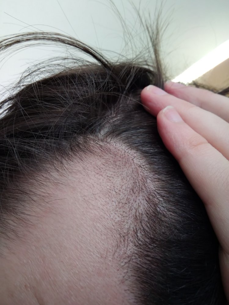 Success With Dutasteride When Failed With Finasteride | HairLossTalk Forums