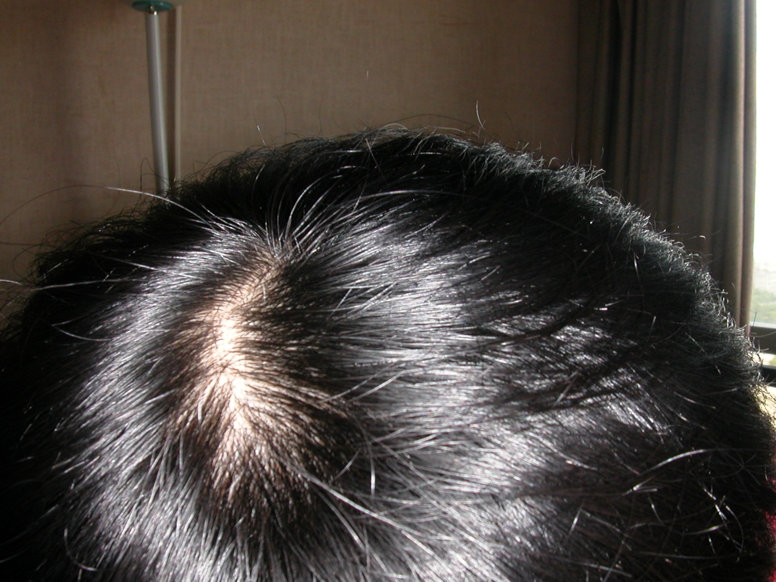 Blading or cowlick??(Updated miniaturization temples) | HairLossTalk Forums