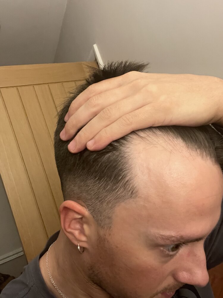Receding hairline - Do I get a transplant or just accept? | HairLossTalk  Forums