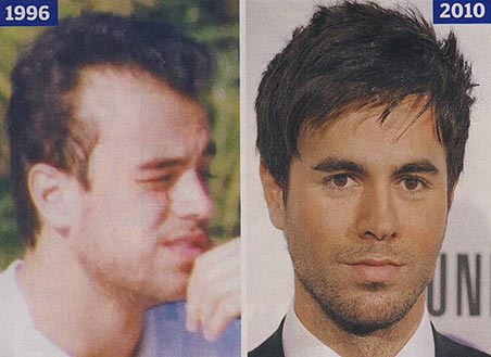enrique-iglesias-balding-bald.jpg