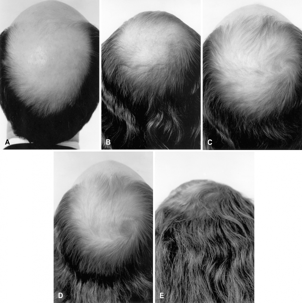 Estrogen therapy.png