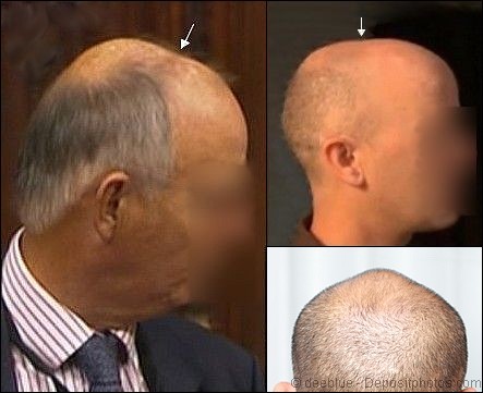 extreme-skull-expansion-and-hair-loss.jpg