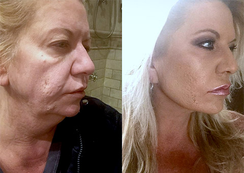facelift-patient-before-and-after-photos-15a.jpg