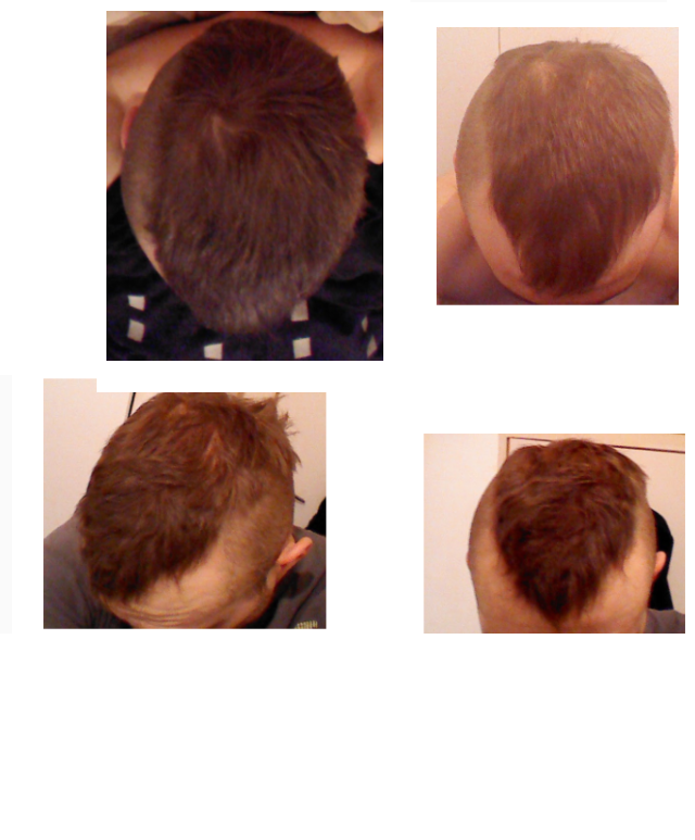 finasteride before after.png