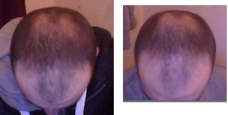 finasteride beter.png