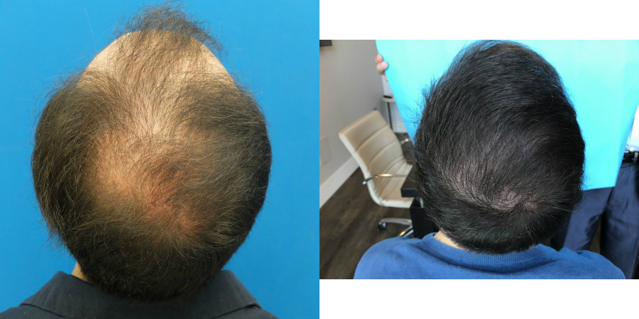 finasteride-gel-hair-transplant-7-months.jpg