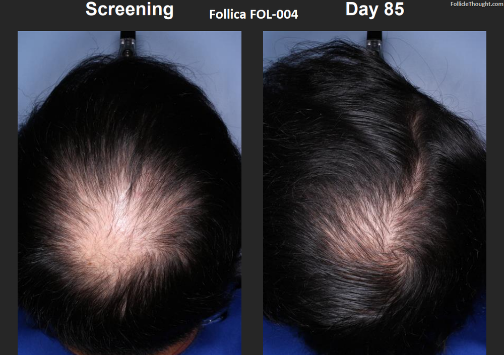 Follica_Hair_Results_Before_After_Close_Up.png