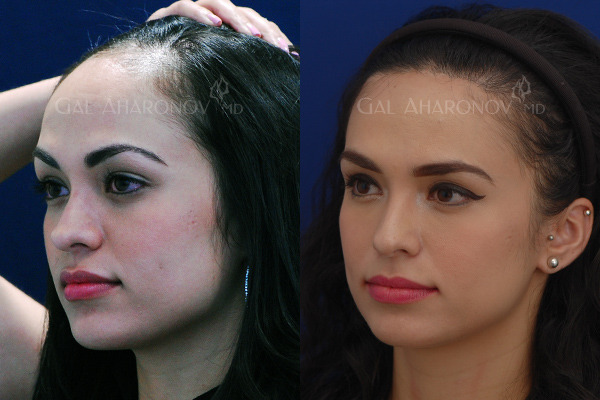 forehead_reduction_surgery_hairline_lowering_surgery_big_forehead_01.jpg