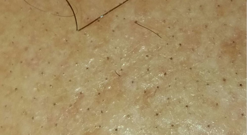 foro HairLossTalk.com detalle.JPG