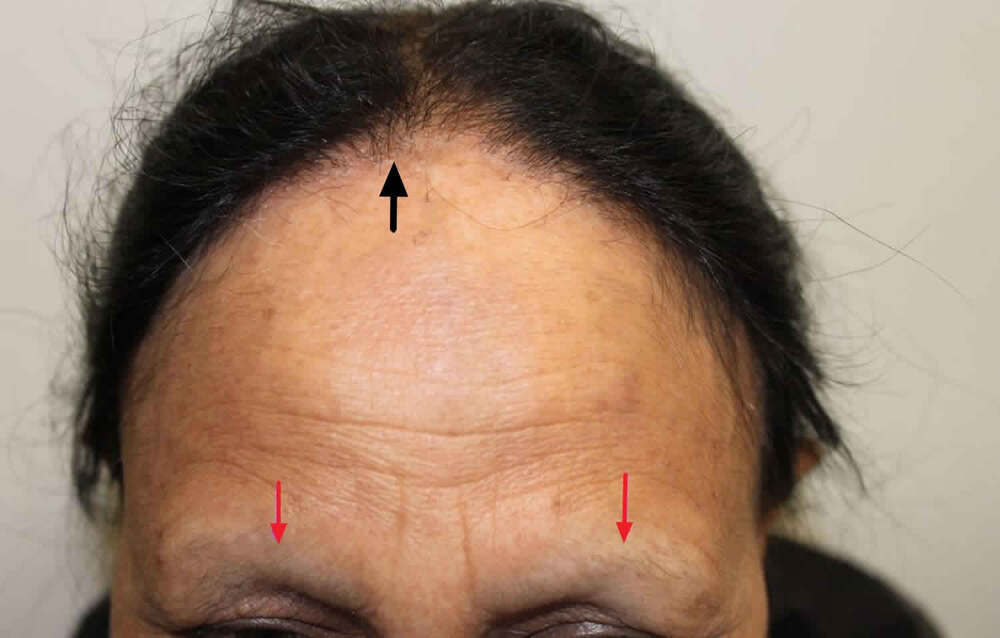 frontal-fibrosing-alopecia.jpg