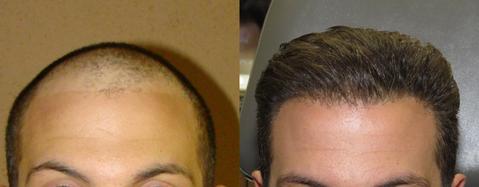 FUE-Hair-Transplant-Before-and-After-1_large.jpg