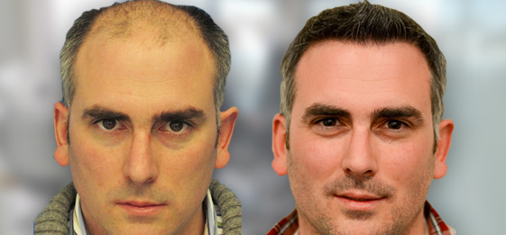 Fue-Hair-Transplant-Before-And-After.jpg