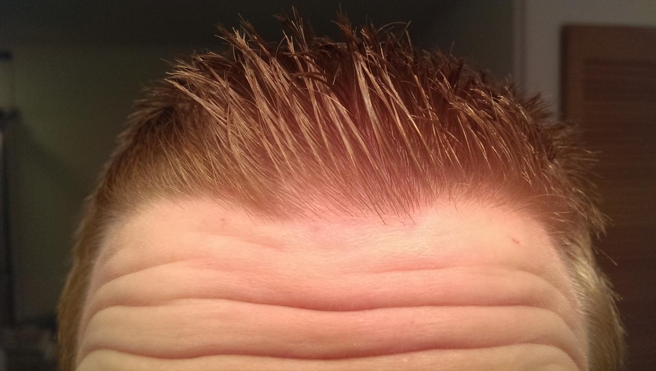 24 Years Old Diffuse Thinning Front Middle | HairLossTalk Forums