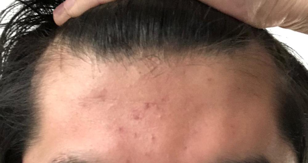 Recovery from accutane hair loss