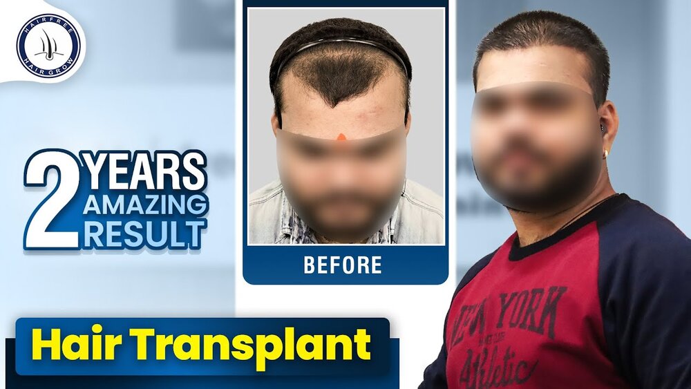 Grade 3 Baldness Hair Transplant in Hyderabad.jpg