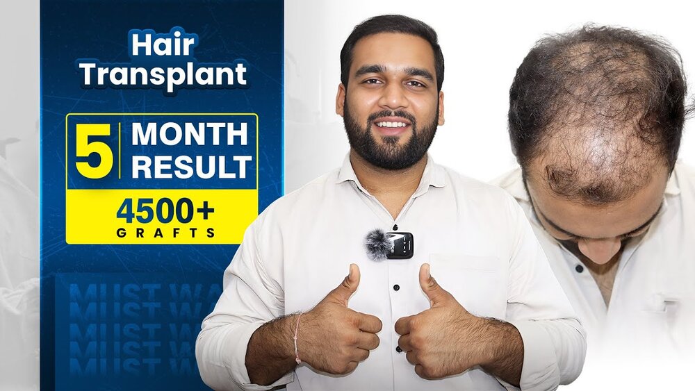 Grade 5 Hair Transplant in Mumbai.jpg
