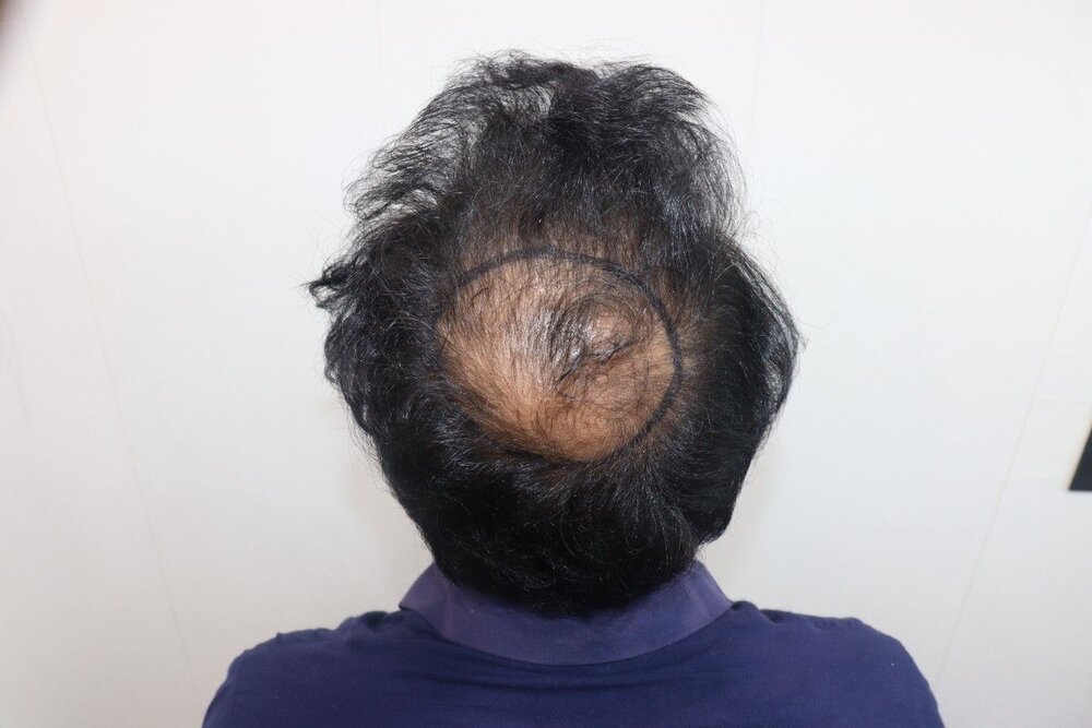 hair line marking.JPG