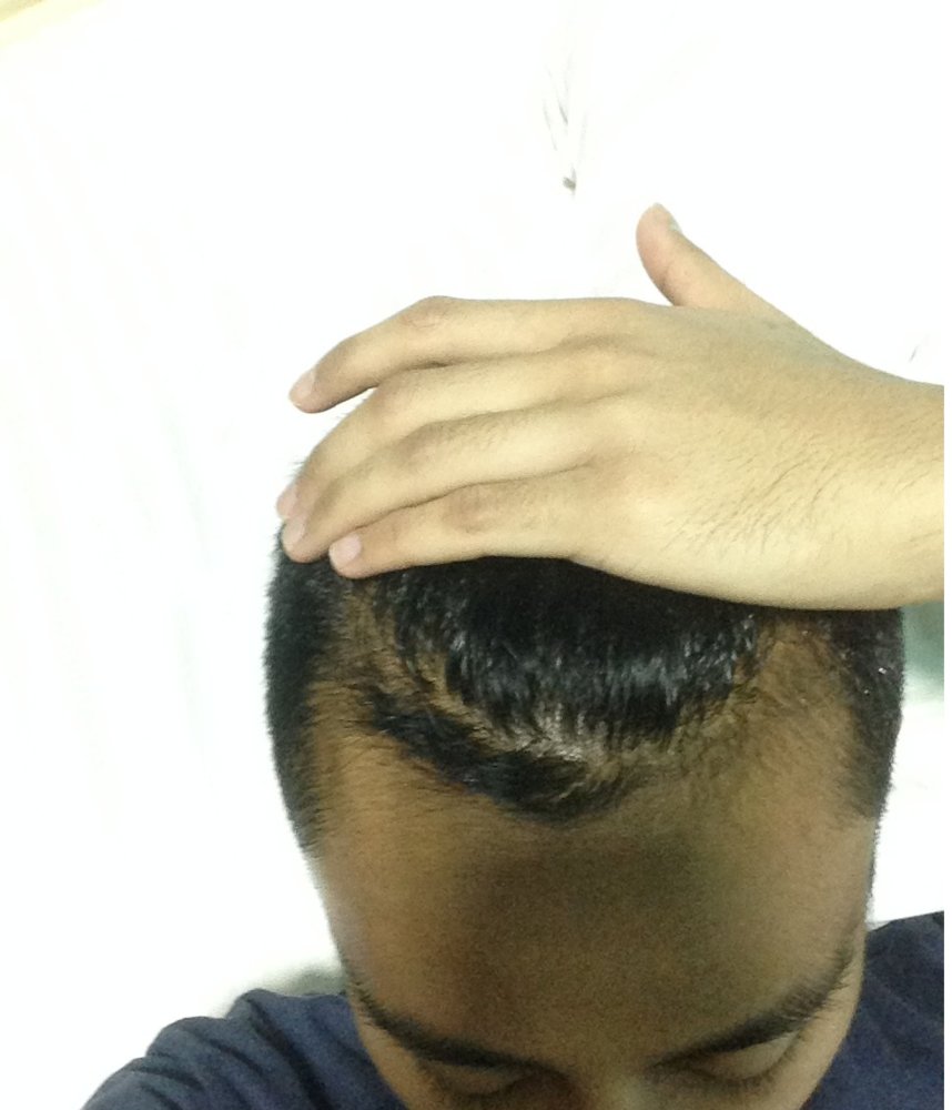 hair loss - 1 Sept 2017.JPG