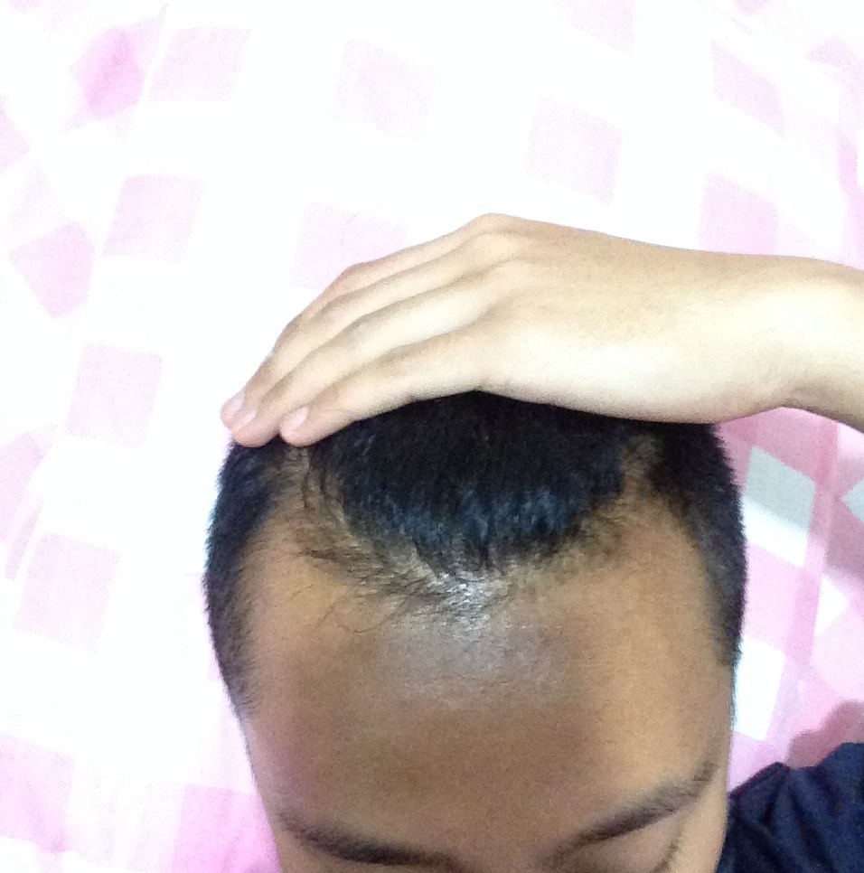 hair loss - 14 Oct 2016.JPG