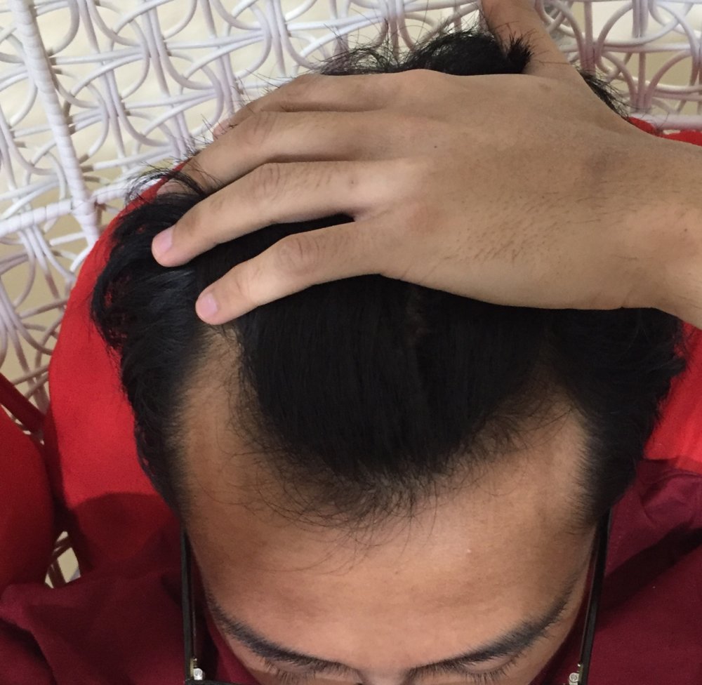 hair loss - 15 Jan 2018.JPG
