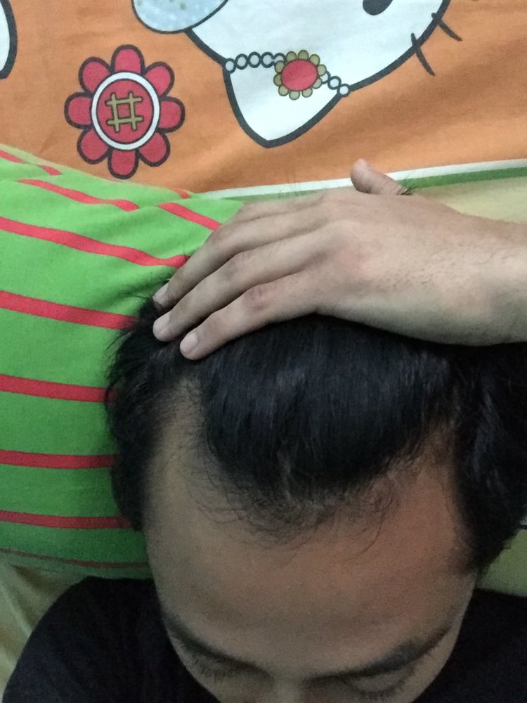 hair loss - 16 Dec 2017.jpg