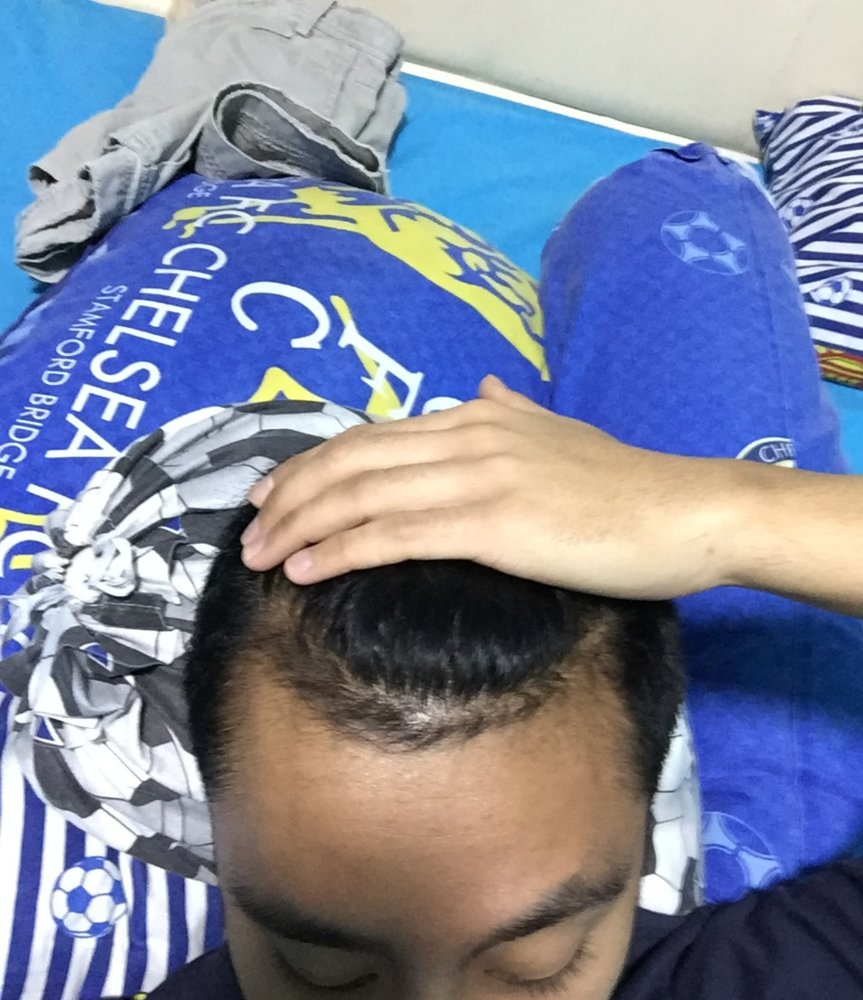 hair loss - 22 Oct 2017.JPG