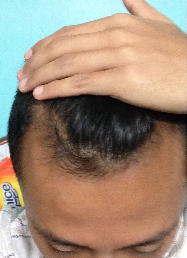 hair loss - 5 March 2017.jpg