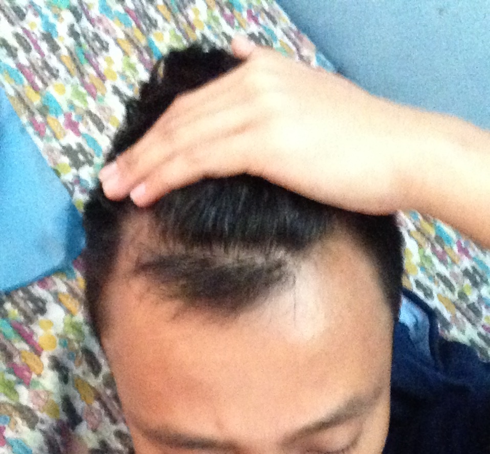 hair loss - 9 July 2015.JPG