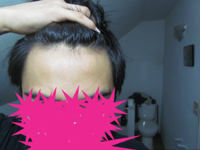 hair loss version 1.jpg