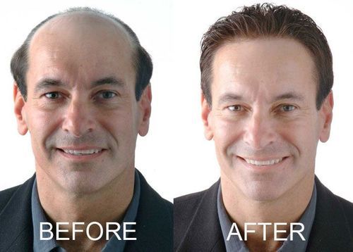 hair-replacement-centre-500x500.jpg