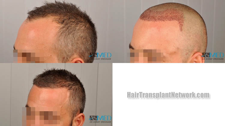 hair-restoration-surgery-photo-left-174097.jpg