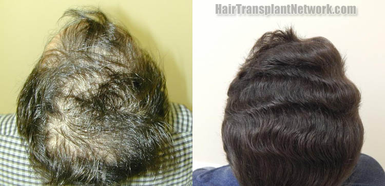 hair-restoration-surgical-procedure-photos-crown-179742.jpg