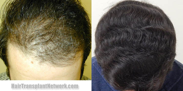 hair-restoration-surgical-procedure-top-179742.jpg